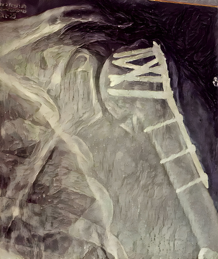 Proximal humerus fracture post ORIF